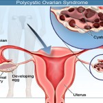 Ovarian Cysts:  Symptoms and Diagnosis